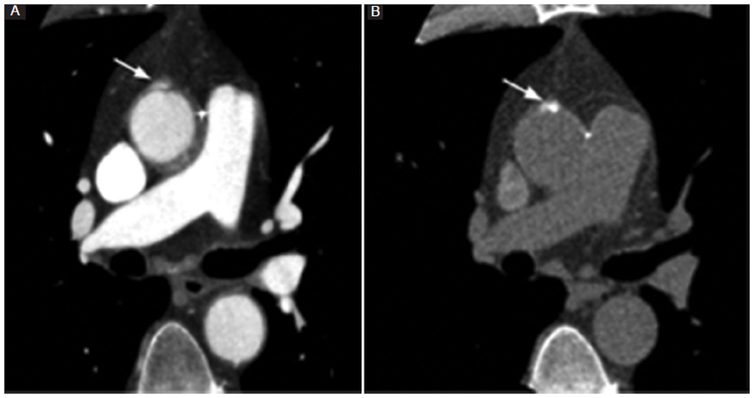 ATCMC tras cirugía de Bentall de Bono. A: reconstrucción axial con contraste intravenoso. B: fase sin contraste intravenoso. Se evidencia una formación sacular hiperdensa en relación con la aorta ascendente (flecha). En la fase sin contraste se observa en la misma topografía una hiperdensidad en relación con el fieltro (flecha), descartándose un pseudoaneurisma.
