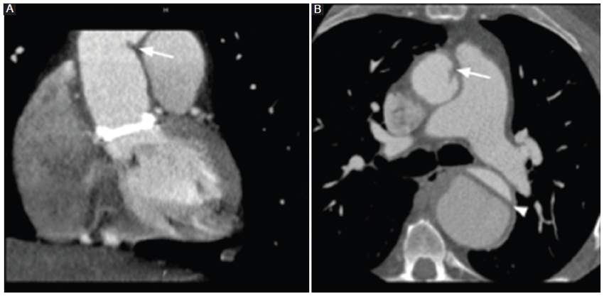 ATCMC tras cirugía de Bentall de Bono. A: reconstrucción coronal con angulación protésica con pseudocolgajo (flecha), simulando un colgajo de disección en la aorta torácica ascendente. B: reconstrucción axial del mismo paciente; se comparan el pseudocolgajo (flecha) dado por la angulación protésica y la presencia de un colgajo de disección real (punta de flecha) en la aorta torácica descendente.