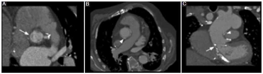 ATCMC tras cirugía de Bentall de Bono. A y B: en plano axial, depósito anular de contraste (flecha) en relación a la válvula aórtica protésica y a la anastomosis término-terminal distal de la prótesis de aorta ascendente (punta de flecha). C: se aprecia la correlación de ambos depósitos en plano coronal.