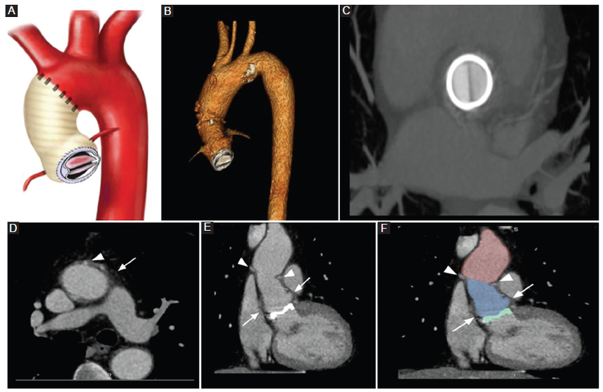 ATCMC que muestra el cambio anatómico de la aorta torácica tras la reparación con procedimiento de Bentall de Bono. A: diagrama que ilustra el sitio de anastomosis entre la aorta y el injerto. B: 3D volume rendering que muestra el aspecto normal posoperatorio del procedimiento. C: prótesis valvular aórtica en reconstrucción MIP axial oblicuo. D: reconstrucción MPR axial con evidencia de los sitios de anastomosis (punta de flecha) y estriación de la grasa mediastinal alrededor de la aorta ascendente en relación con un procedimiento quirúrgico reciente (flecha). E y F: reconstrucción coronal MPR del injerto artificial aórtico (sección celeste) que involucra los botones coronarios (flechas), cambio en el contorno de la aorta ascendente (sección rosa), sitio de anastomosis distal (puntas de flecha) y próstesis valvular (sección verde).