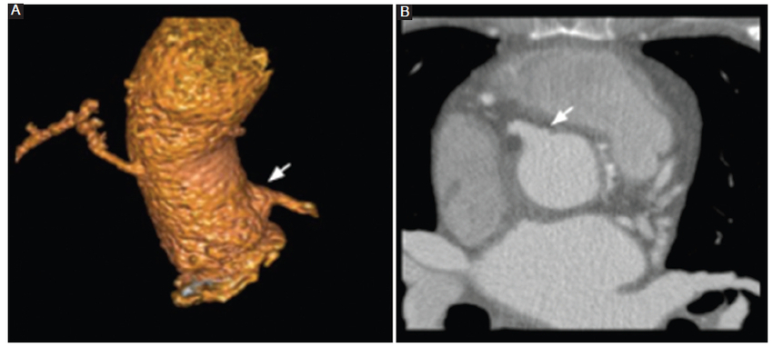 ATCMC. A: 3D volume rendering que muestra el cambio anatómico de la arteria coronaria izquierda (flecha) tras su reimplantación con la técnica del botón de Bentall. B: reconstrucción MPR en el plano axial oblicuo.