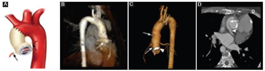 ATCMC que muestra los cambios anatómicos de la aorta ascendente y las arterias coronarias tras la reparación con procedimiento de Cabrol. A: diagrama ilustrativo del sitio de anastomosis entre la prótesis aórtica, la válvula aórtica, la prótesis coronaria y las anastomosis termino-terminal (flechas) con las coronarias nativas. B: 3D volume rendering que muestra la vista posterior de la aorta y la prótesis coronaria (flecha). C: 3D volume rendering que muestra la vista anterior con la válvula mecánica (punta de flecha) y la prótesis de aorta ascendente con sus respectivas anastomosis proximal y distal (flechas). D: plano axial que muestra las anastomosis latero-lateral (flecha) y término-terminal (punta de flecha) de la prótesis coronaria.