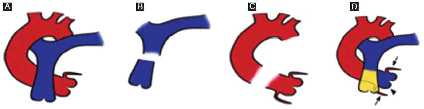 Representación esquemática del procedimiento de Ross. A: disposición habitual de las arterias aorta (rojo) y pulmonar (azul). B: resección del tercio proximal y la válvula de la arteria pulmonar. C: disección de la arteria aorta junto con sus arterias coronarias y la válvula aórtica. D: anastomosis del homoinjerto pulmonar (punta de flecha) con su correspondiente válvula a las arterias coronarias nativas (flechas) y al tracto de salida del ventrículo izquierdo; prótesis pulmonar (amarillo) en el tracto de salida del ventrículo derecho.