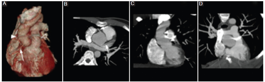 ATCMC que muestra los cambios anatómicos tras la cirugía de Ross. A: 3D volume rendering que evidencia la anastomosis del homoinjerto en la aorta (punta de flecha), la arteria coronaria derecha (flecha) y la bioprótesis tubular valvulada en la arteria pulmonar (punta de flecha hueca). B: reconstrucción MIP axial oblicuo del homoinjerto de la arteria aorta y ambas arterias coronarias (flechas). C: reconstrucción MIP coronal de la arteria aorta con los sitios de anastomosis (puntas de flecha). D: reconstrucción MIP coronal de la arteria pulmonar con la bioprótesis tubular valvulada (punta de flecha hueca).