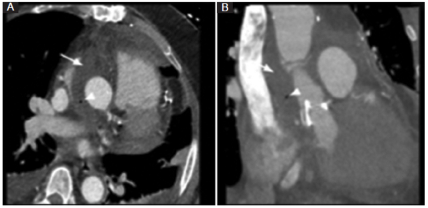 ATCMC de un paciente asintomático a las 4 semanas de una cirugía de Bentall de Bono. A: reconstrucción axial. B: reconstrucción coronal oblicua. Se observa líquido periprotésico (flecha) con presencia aislada de burbuja aérea (punta de flecha) en su interior.