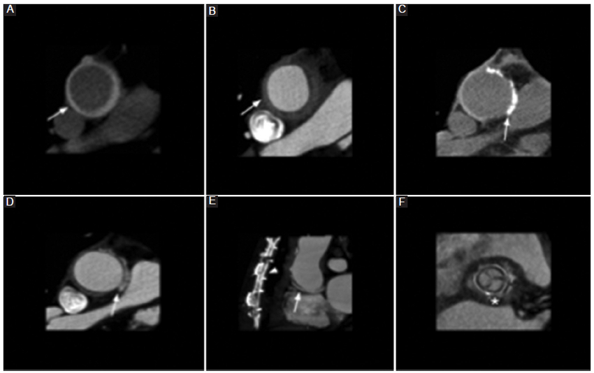 ATCMC de la aorta torácica. A: imagen axial en TC sin contraste que muestra un injerto de polietileno sintético (dacrón) que es hiperdenso y circunferencial en relación a la luz aórtica (flecha), y puede simular un hematoma intramural (pitfall).B: tras la administración de contraste intravenoso, el injerto se torna hipodenso (flecha). C: la imagen axial en TC sin contraste y D: la imagen axial tras la administración del contraste muestran el material de fieltro en el sitio de la anastomosis, que es hiperdenso (flecha) en relación a la luz aórtica y más notorio en la fase sin contraste. E: reconstrucción sagital MIP que muestra las huellas de la esternotomía (punta de flecha) y material de fieltro en el sitio de la anastomosis (flecha). F: reconstrucción axial oblicua MPR que muestra la prótesis biológica (asterisco).