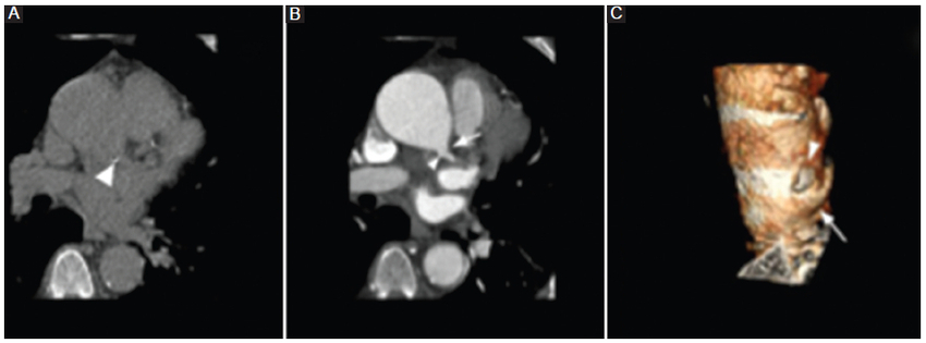 ATCMC tras cirugía de Bentall de Bono. A: reconstrucción axial sin contraste. B: con contraste intravenoso. Se evidencia una formación sacular hiperdensa en relación al ostium de la arteria coronaria izquierda (flecha), con calcificación parietal (punta de flecha), atribuible a un cambio quirúrgico de la técnica de botón de Bentall. C: 3D volume rendering del mismo paciente que pone de manifiesto la calcificación parietal (punta de flecha) y el botón de Bentall (flecha).