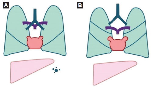 En este gráfico se representan algunos de los hallazgos anatómicos del síndrome de heterotaxia. A: síndrome de heterotaxia con poliesplenia: pulmones bilobulados, bronquios fuente largos e hipoarteriales, aurículas de drenaje pulmonar, hígado «en puente» y múltiples bazos. B: síndrome de heterotaxia con asplenia: pulmones trilobulados y bronquios epiarteriales, aurículas sistémicas, hígado «en puente» y ausencia de bazo.