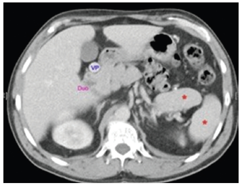 Caso 4. TC de abdomen en el plano axial con medio de contraste intravenoso en fase portal. Se identifica vena porta (VP) en una disposición preduodenal. Duodeno (Duo). Se observan dos imágenes con realce similar al tejido esplénico (*) compatible con múltiples bazos.