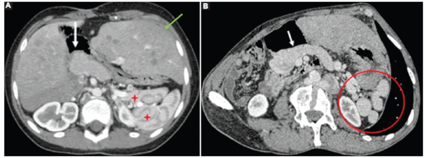 A: caso 3. Tomografía computarizada (TC) de abdomen con medio de contraste intravenoso en fase arterial, reconstrucción axial oblicua. Se identifica páncreas trunco (corto) (flecha). Nótese la gran hepatomegalia a predominio del lóbulo izquierdo ubicado en la línea media y múltiples bazos (asteriscos rojos). B: caso 1. TC abdomen con medio de contraste en fase portal reconstrucción axial oblicuo. Se observa páncreas trunco (flecha) y múltiples bazos (círculo rojo).