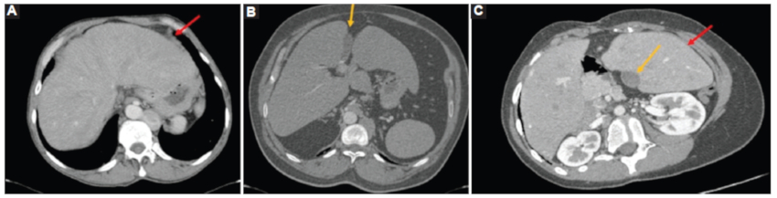 A: caso 1. TC de abdomen con medio de contraste intravenoso en fase arterial, corte axial oblicuo en ventana de abdomen. Nótese hígado en línea media con hipertrofia del lóbulo izquierdo (flecha roja). B: caso 2. TC de tórax con medio de contraste intravenoso en fase arterial, corte axial en ventana de abdomen. Se observa hígado y vesícula biliar (flecha naranja) en disposición medial. C: caso 3. TC de abdomen con medio de contraste intravenoso en fase arterial. Corte axial oblicuo en ventana de abdomen, se observa hepatomegalia con disposición en puente e hipertrofia del lóbulo izquierdo (flecha roja) y vesícula biliar en línea media (flecha naranja).