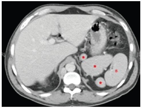Caso 4. TC con medio de contraste intravenoso en fase portal. Corte axial en ventana de abdomen. Se observan al menos cuatro formaciones sólidas con el mismo comportamiento que el bazo (B). *Poliesplenia.