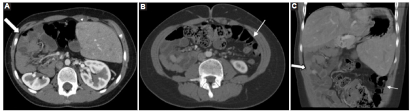 Caso 3. TC con medio de contraste intravenoso. A y B: cortes axiales en ventana de abdomen. A: intestino delgado replegado en hemiabdomen derecho (flecha gruesa). B: colon replegado en hemiabdomen izquierdo (flecha fina). C: corte coronal en ventana de abdomen. Se observa la disposición de asas delgadas en hemiabdomen derecho (flecha gruesa) y colon de disposición en hemiabdomen izquierdo (flecha fina).