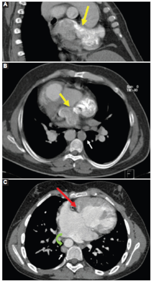 A: caso 2. TC de tórax con medio de contraste intravenoso. Corte coronal oblicuo en el eje corto a nivel de las aurículas. Opacificación precoz de la aurícula contralateral, shunt (flecha amarilla). B: caso 2. Corte axial de tórax. Se observa nuevamente la opacificación precoz de la aurícula contralateral (flecha amarilla). Vena ácigos aumentada de tamaño (flecha blanca). C: caso 3. Corte axial con medio de contraste intravenoso en fase arterial. Canal auriculoventricular (flecha roja). Aorta descendente derecha (flecha verde curva). Adyacente a esta se observa la vena ácigos aumentada de tamaño.