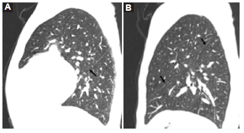 Caso 1. TC de tórax, ventana de pulmón. Pulmones bilobulados con la presencia de una única cisura (flechas negras). A: corte sagital de pulmón derecho. B: corte sagital de pulmón izquierdo.
