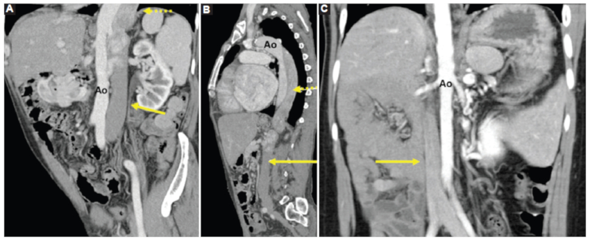 A: caso 1. TC toraco‑abdominal con medio de contraste intravenoso, reconstrucción coronal oblicuo multiplanar (MPR). Se observa vena cava inferior infrarrenal (flecha amarilla) con recorrido a la izquierda de la aorta (Ao). Luego se continua como vena ácigos (flecha amarilla punteada) aumentada de calibre, manteniendo su relación a la izquierda de la aorta. B: caso 1. TC toraco‑abdominal con medio de contraste intravenoso en fase portal y reconstrucción MPR corte sagital oblicuo. Ausencia de vena cava inferior retrohepática (flecha amarilla). Vena ácigos aumentada de tamaño en todo su recorrido (flecha amarilla punteada). C: caso 3. TC de abdomen con medio de contraste intravenoso en fase arterial, reconstrucción MPR corte coronal oblicuo. Se observa vena cava inferior (flecha amarilla) que discurre a la derecha de la Ao.