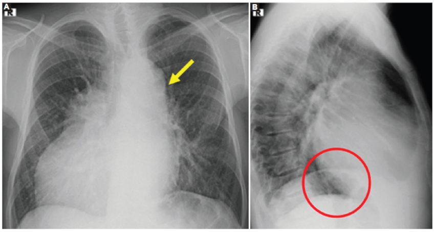 A: caso 1. Radiografía de tórax proyección frontal. Dextrocardia. Prominente cayado aórtico izquierdo, acompañado del cayado de la vena ácigos (flecha amarilla). B: radiografía de tórax perfil. Ausencia de la proyección de la vena cava inferior (círculo rojo).