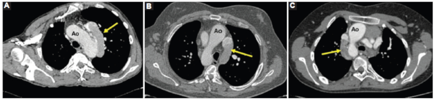 A: caso 1. TC de tórax con medio de contraste intravenoso corte axial oblicuo. Se observa prominente cayado de vena ácigos a la izquierda de la aorta. B: caso 2. TC de tórax con medio de contraste intravenoso corte axial. Cayado de la vena ácigos a la izquierda de la aorta. C: caso 3. TC de tórax con medio de contraste intravenoso corte axial. Cayado de la vena ácigos a la derecha (cayado de vena ácigos: flecha amarilla). Ao: aorta.