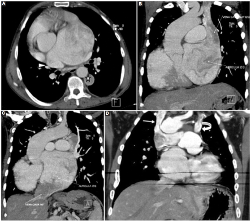 Caso 1. TC de tórax con medio de contraste intravenoso. A: corte axial, se observa desembocadura de la vena pulmonar superior derecha en la aurícula derecha (cabeza de flecha). Vena ácigos a la izquierda de la aorta (estrella). B y C: reconstrucción MIP (maximum intensity projection) en un corte coronal. Se observa la llegada de la circulación sistémica (vena cava superior e inferior) a la aurícula izquierda. D: caso 3. TC de tórax con medio de contraste intravenoso, corte coronal oblicuo. Artefacto metálico. Se observa vena cava superior derecha drenando junto a la vena ácigos a nivel de la arteria pulmonar derecha (flecha blanca). Se visualiza un sector de la vena cava superior izquierda (flecha curva).