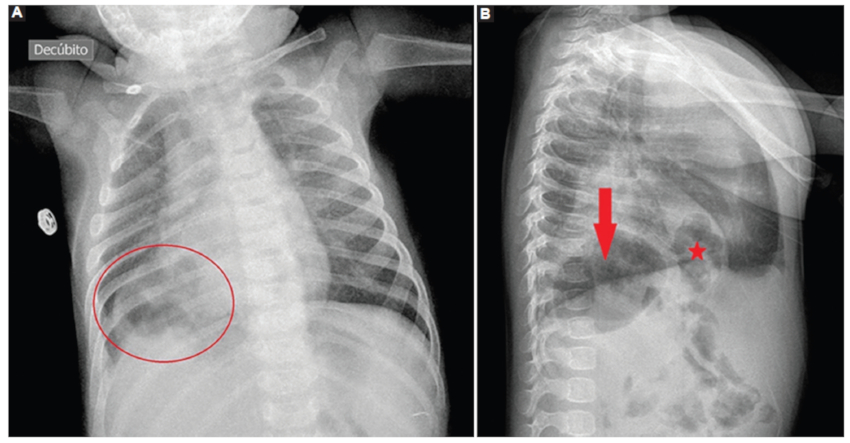 A: radiografía anteroposterior. B: lateral de tórax observando ocupación de base pulmonar derecha por contenido gaseoso (círculo) que impresiona de estómago (flecha) e intestino (estrella).