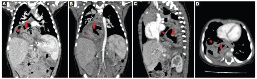 A y B: tomografía computada (TC) toraco-abdominal con contraste intravenoso, cortes coronales. C: sagital. D: axial objetivando estómago intratorácico (flechas) y parte del marco cólico derecho (estrella).