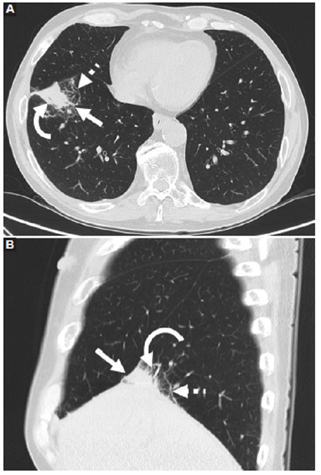 Hombre de 67 años con diagnóstico reciente de carcinoma orofaríngeo en estudio para estadificación con TC sin contraste. A: imagen axial que muestra consolidación pulmonar en el lóbulo inferior derecho (flecha) con fino broncograma aéreo (flecha curva) y áreas de reticulación periférica (flecha rayada). B: imagen sagital que confirma consolidación en contacto con la pleura basal y la cisura mayor (flecha) con fino broncograma aéreo (flecha curva) y áreas de reticulación periférica (flecha rayada).