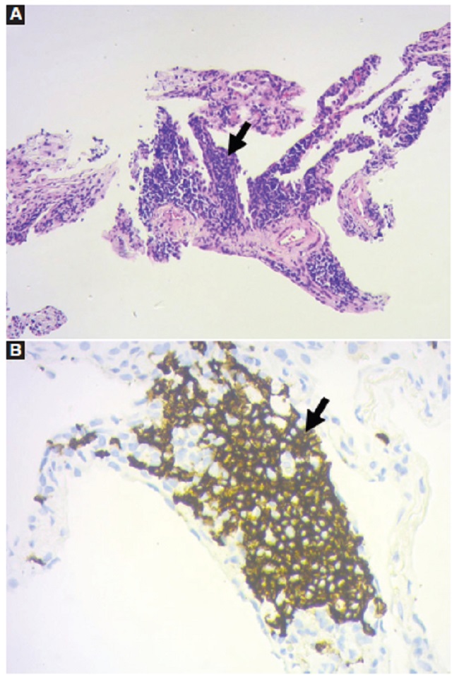 Microfotografía de biopsia histológica obtenida mediante punción pulmonar con aguja de corte 18 G. A: fragmento de tejido pulmonar con infiltración por linfocitos de pequeño tamaño (flecha) (técnica de hematoxilina-eosina, 4x). B: componente linfoide positivo con CD20 (flecha) (técnica de inmunohistoquímica CD20, 10x).