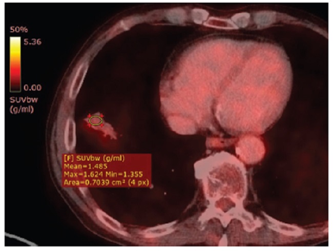 Control postratamiento mediante PET-TC por emisión de positrones con 18-fluorodesoxiglucosa. Se puede apreciar reducción en el tamaño de la consolidación pulmonar en seguimiento y disminución en su actividad metabólica (SUV: 1,4) (ROI).