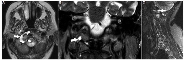 RM de la unión craneocervical. A: corte axial. B: corte coronal T2. C: corte sagital STIR. Se observa (flecha larga), a nivel de la AAO derecha, una colección líquida que adopta una configuración en C, correspondiendo a DAAO. Se señalan la arteria carótida interna (punta de flecha) y la arteria vertebral (flecha corta).