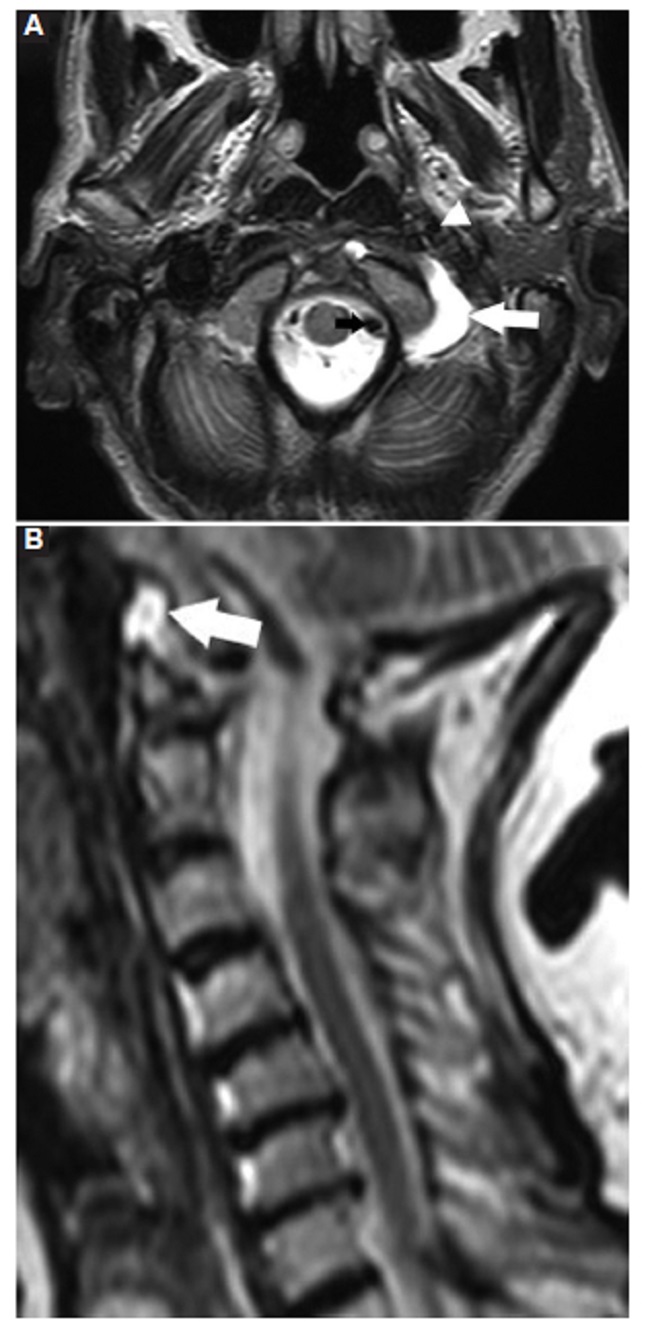 RM de columna cervical. A: corte axial. B: corte sagital. Ponderados en secuencia T2. Se aprecia derrame articular en forma de C en la AAO izquierda (flecha blanca). Se señalan la arteria carótida interna (punta de flecha) y la arteria vertebral (flecha negra).