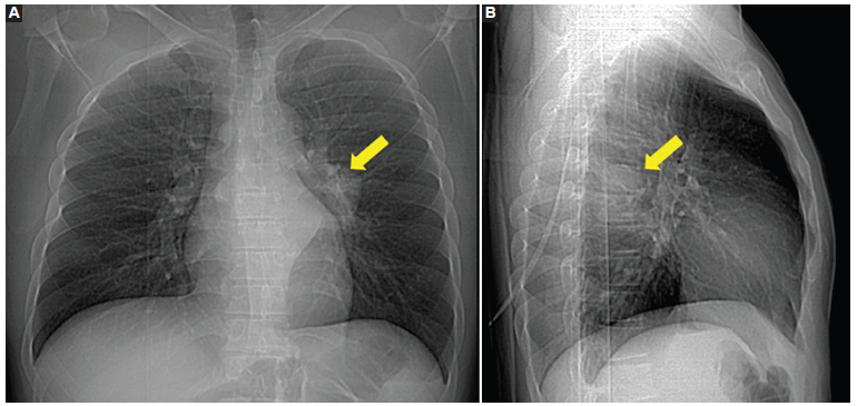 Radiografía de tórax. A: de frente. B: de perfil. En la proyección posteroanterior (A) se observa una opacidad en el tercio medio del tórax, con amplia relación con las estructuras mediastinales, y márgenes bien definidos con el campo pulmonar izquierdo. El borde medial no se identifica. Presenta ángulos obtusos, lo que orienta a una masa de localización mediastinal. No presenta signo de la silueta con las estructuras cardíacas, pero sí con la columna, y borra las líneas paraaórtica y paravertebral izquierda, lo cual la localiza en el mediastino posterior. En la proyección de perfil (B) se observa un aumento de la densidad focal a nivel de las vértebras torácicas medias, confirmando dicha topografía.