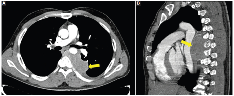 TC. A: plano axial. B: plano sagital. Con contraste yodado intravenoso en fase arterial. Se observa una voluminosa tumoración sólida en el tercio medio del mediastino posterior (flecha). Por su sector anterior contacta y desplaza hacia delante a la aorta torácica descendente. Engloba los vasos intercostales y desplaza anteriormente la vena pulmonar inferior izquierda. Contacta y desplaza el tercio medio del esófago. Contacta ampliamente con los cuerpos vertebrales, en los que no se identifican alteraciones, y con los arcos costales izquierdos, en los que se evidencia un mínimo adelgazamiento de la cortical, sin interrupción de esta. Por su sector posterior, la tumoración se introduce al canal raquídeo a través del quinto, sexto y séptimo neuroforámenes izquierdos.