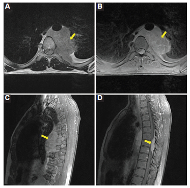 RM. A: plano axial, potenciado en T2. B: plano axial, potenciado en T1 con gadolinio. C y D: plano sagital, potenciado en T1 con gadolinio. Se observa la tumoración (flecha) con epicentro en el mediastino posterior, que es isointensa en T2 y presenta realce moderado y homogéneo con el gadolinio. Se introduce al interior del canal raquídeo por los neuroforámenes de T5-T6, T6-T7 y T7-T8. Ocupa el interior del canal en su sector posterolateral izquierdo y disminuye en forma grave el diámetro de este. Desplaza la médula espinal hacia delante y hacia la derecha, la cual no presenta alteraciones en su señal.