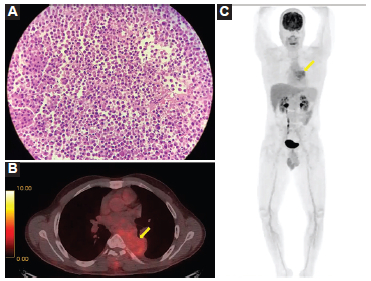 PET/TC 18F-FDG. A: biopsia de la tumoración, tinción con hematoxilina-eosina. Muestra una proliferación celular de patrón difuso integrada por células de mediana talla de núcleos redondeados, sin nucléolo y con citoplasma eosinófilo de aspecto plasmocítico. B: imagen seleccionada en el plano axial. Se observa la tumoración mediastinal con densidad de partes blandas, hipermetabólica, con distribución heterogénea del radiotrazador (flecha). C: proyección de máxima intensidad (MIP) de cuerpo entero, en la que se observa captación anormal en el mediastino posterior (flecha). No se identifican otras áreas de captación a nivel óseo.