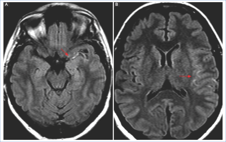 (A) Secuencia FLAIR. Hiperseñal intraluminal en el segmento M1 de la ACM izquierda. (B) Mismo hallazgo en ramas distales, probablemente debido a hipoflujo, en un paciente con oclusión de la ACI homolateral (flechas).