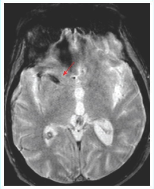 Secuencia de susceptibilidad magnética (GRE T2). Trombo hipointenso en topografía de M1 derecha, sugestivo de etiología cardioembólica (flecha).