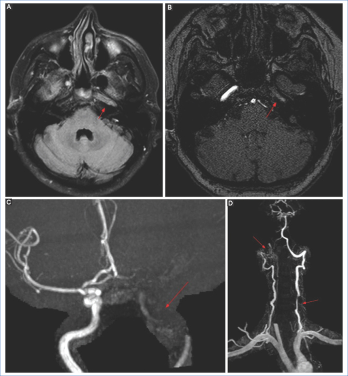 Disecciones arteriales. (A) Secuencia FLAIR axial donde se observa ausencia del vacío de flujo normal en el segmento petroso de la ACI izquierda, con hiperseñal intraluminal (flecha). (B) 3D-TOF GRE, no se observa flujo en el interior de la arteria (flecha). (C) Reconstrucción MIP, aspecto irregular de la carótida interna izquierda (flecha). (D) Otro paciente en el cual se visualiza disección de ambas arterias vertebrales, a derecha en segmento V3-4 y a izquierda en V2 (flechas).