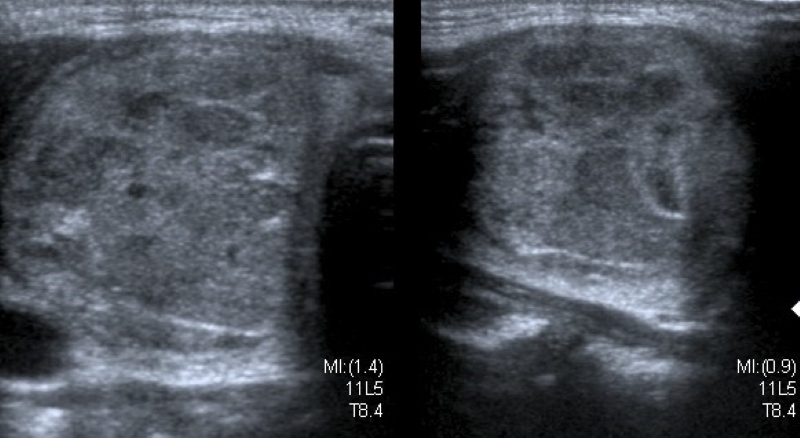 Carcinoma folicular en paciente de 10 años. Corte transversal en escala de grises de lóbulo tiroideo derecho. Se observa imagen heterogénea de aspecto sólido que compromete casi la totalidad del lóbulo y desplaza hacia lateral arteria carótida.