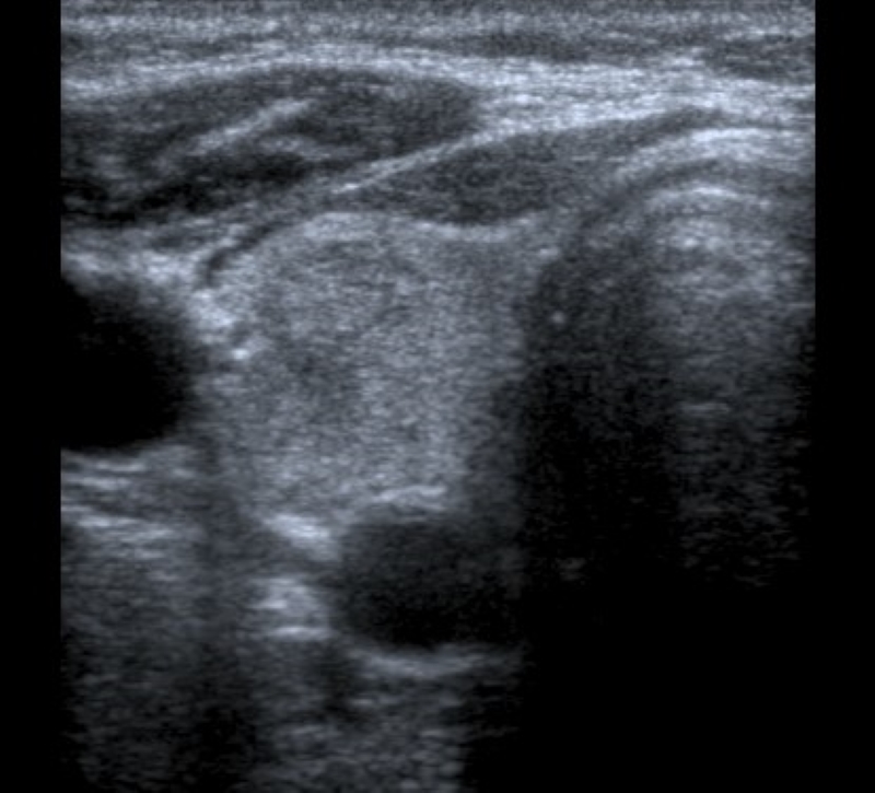Carcinoma folicular en paciente de 14 años. Corte transversal en escala de grises de lóbulo tiroideo derecho. Se visualiza imagen nodular isoecoica respecto al parénquima tiroideo adyacente, que impresiona comprometer casi la totalidad del lóbulo.