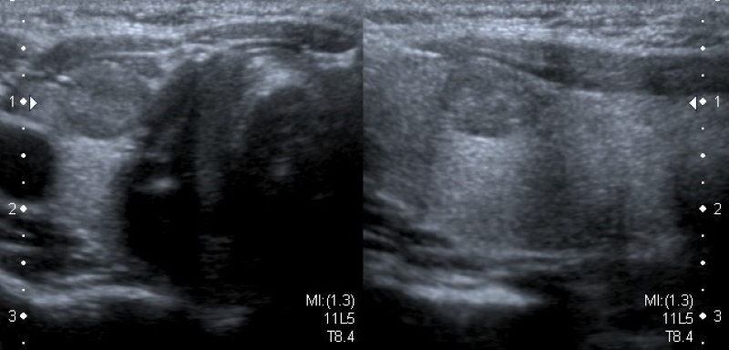 Carcinoma folicular variante oncocítica en paciente de 8 años. Corte transversal y longitudinal en escala de grises de lóbulo tiroideo derecho. Se visualiza imagen nodular hipoecoica respecto al parénquima tiroideo adyacente, de bordes bien definidos e irregulares.