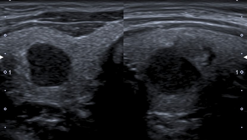 Carcinoma papilar en paciente de 9 años. Cortes transversal y longitudinal en escala de grises de lóbulo tiroideo derecho. Se visualiza imagen nodular de ecoestructura muy hipoecoica con área de mayor ecogenicidad en región antero-inferior. Bordes bien definidos en región superior y mal definidos en porción inferior del nódulo.