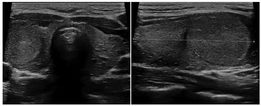 Corte transversal y longitudinal en escala de grises del lóbulo tiroideo derecho. Se observa imagen nodular bien definida, isoecoica y homogénea, con fino halo hipoecoico periférico.