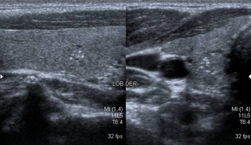 Corte longitudinal y transversal en escala de grises a nivel tiroideo, donde se visualiza en lóbulo derecho nódulo isoecoico de límites poco definidos con imágenes ecogénicas puntiformes moteadas compatibles con microcalcificaciones.