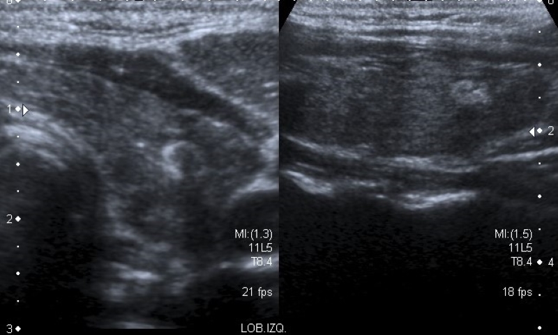 Corte transversal y longitudinal en escala de grises a nivel del lóbulo tiroideo izquierdo, que evidencia imagen nodular con imágenes ecogénicas de distribución excéntrica y con sombra acústica posterior, compatibles con macrocalcificaciones.