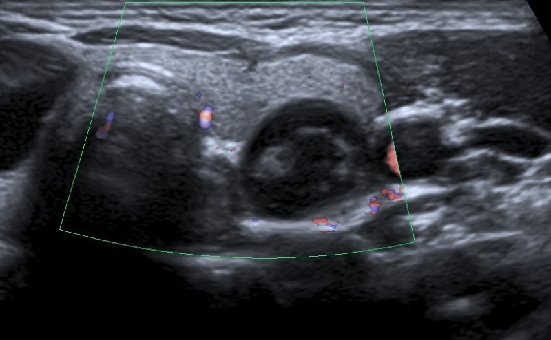 Corte transversal a nivel de glándula tiroides, donde se evidencia imagen nodular quística, en región caudal del lóbulo izquierdo, sin vascularización al examen Doppler color.