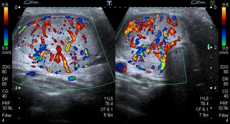 Corte longitudinal y transversal a nivel tiroideo, donde se visualiza en lóbulo derecho voluminosa imagen nodular sólida con aumento de la vascularización tanto periférica como central con disposición caótica al examen Doppler color, con una distribución aleatoria de vasos centrales no ramificados.