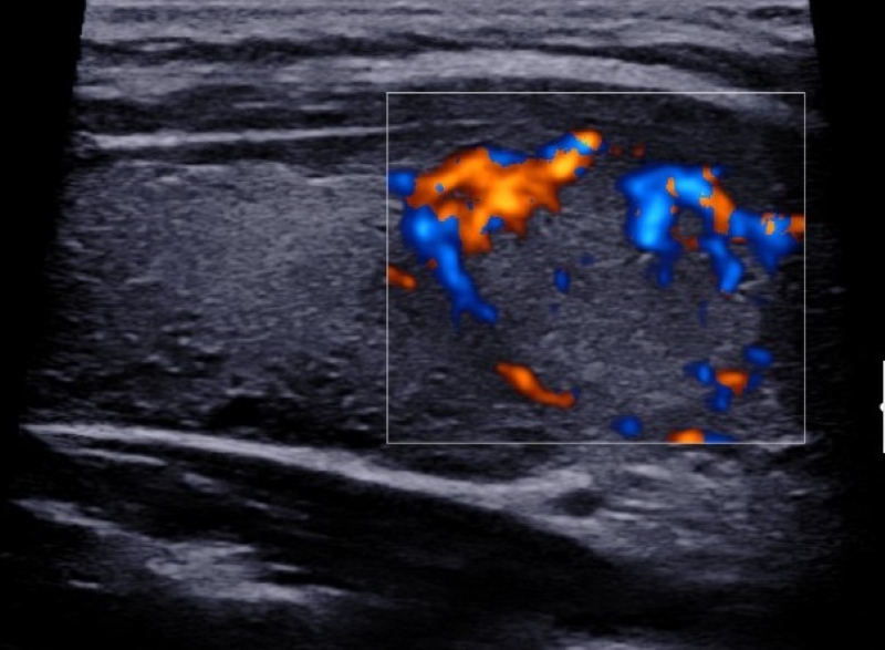 Corte longitudinal a nivel lóbulo tiroideo derecho donde se observa en su polo inferior, imagen nodular isoecoica con vascularización periférica al examen Doppler color.