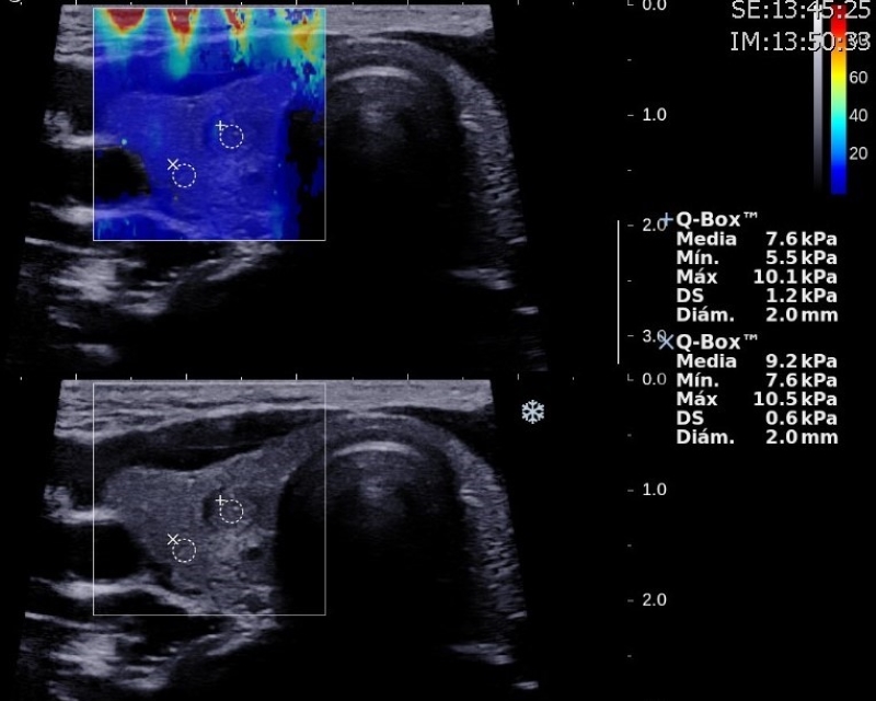 Adenoma folicular en paciente de 15 años. Examen de elastografía de imagen nodular en lóbulo tiroideo derecho. El ROI se coloca en el interior del nódulo y otro en el parénquima tiroideo normal. El nódulo presenta un valor medio de rigidez de 7,6 kPa, incluso menor que el parénquima normal, compatible con hallazgos benignos.