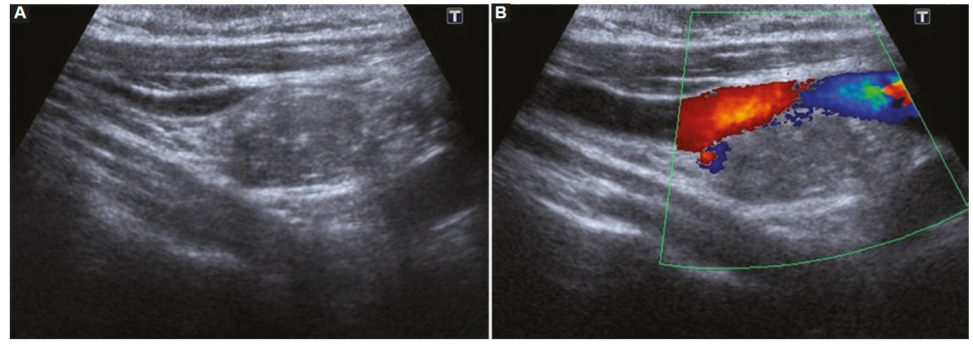 Corte longitudinal en escala de grises (A) y con Doppler color (B) a nivel laterocervical derecho. Se observa imagen ganglionar redondeada, aumentada de tamaño, heterogénea con calcificaciones en el interior y ausencia de hilio ecogénico que desplaza hacia anterior a la arteria carótida homolateral, compatible con adenopatía.