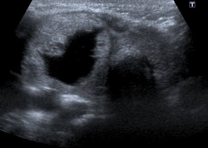 Adenoma folicular en paciente de 8 años. Corte transversal en escala de grises de lóbulo tiroideo derecho. Se visualiza imagen nodular de composición mixta con área sólida de disposición periférica y quística central.